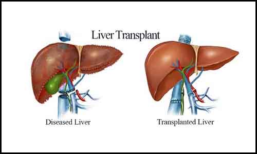 A Comprehensive Guide to Procedure, Types & Cost