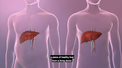 UPMC Living-Donor Liver Transplant